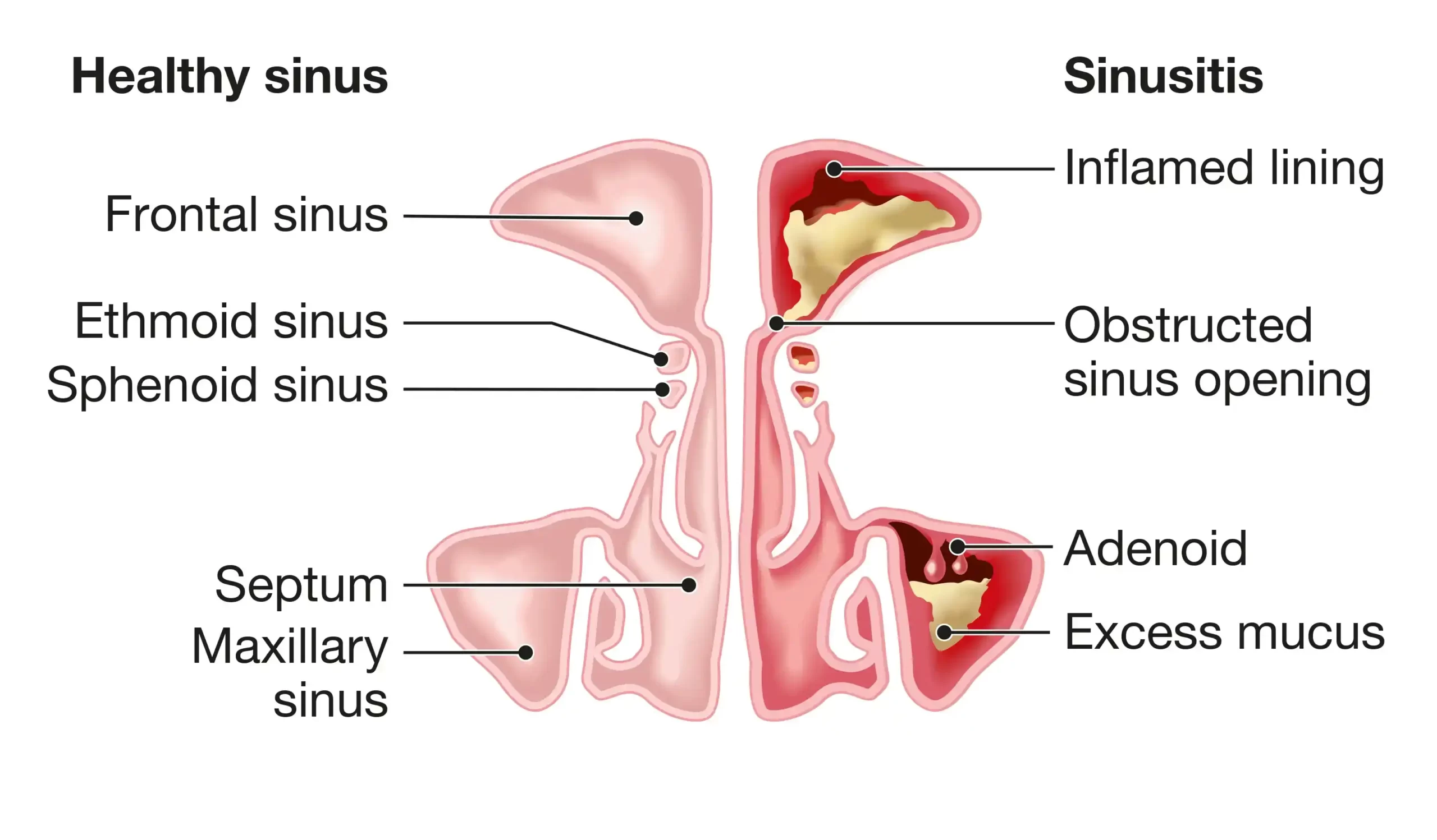 illustration of health sinus and sinusitis